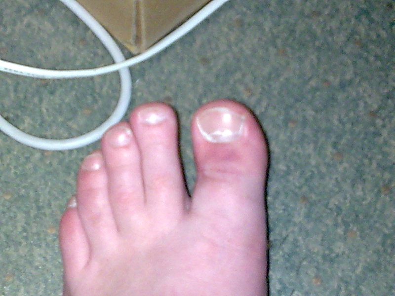 me toe